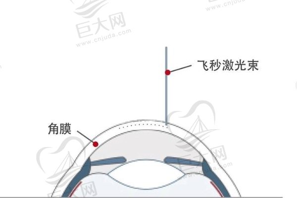 请问当兵近视手术怎么选？