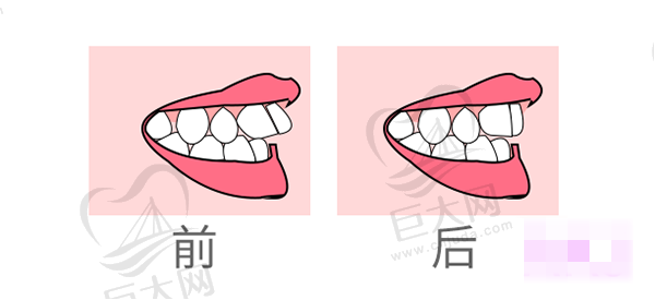 龅牙矫正的方法