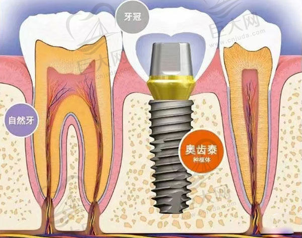 韩国奥齿泰种植牙
