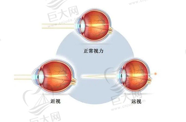 近视眼1000度失明几率大吗？近视1000度是不是废了