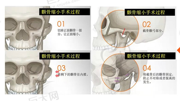 黄敬夏颧骨内推做得怎么样？