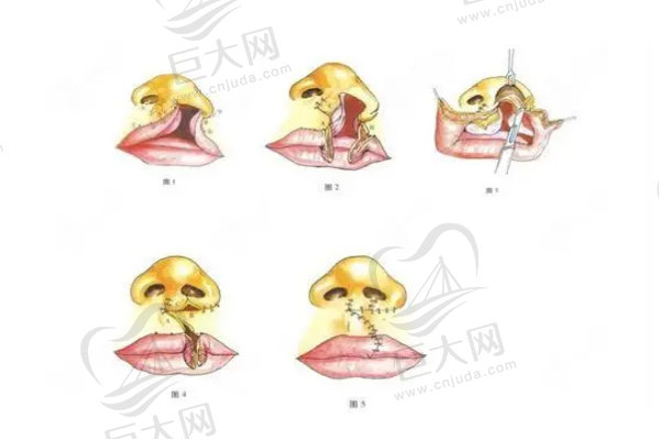 唇腭裂修复流程图