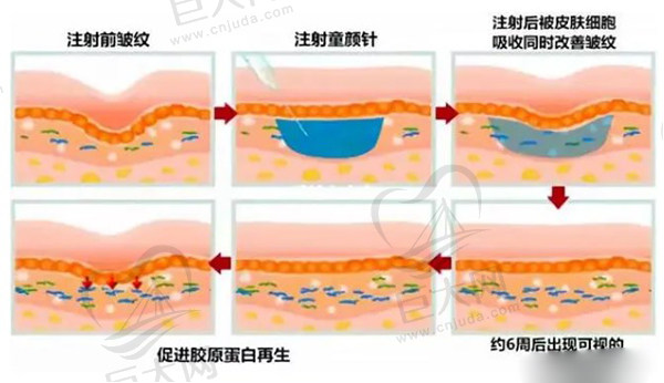 艾维岚童颜 针的作用和成效