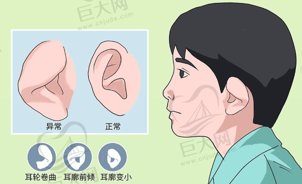 耳畸形矫正