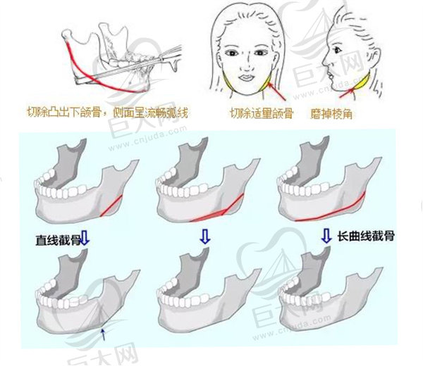 下颌骨磨骨