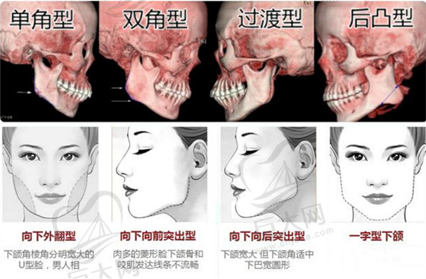 下颌骨磨骨