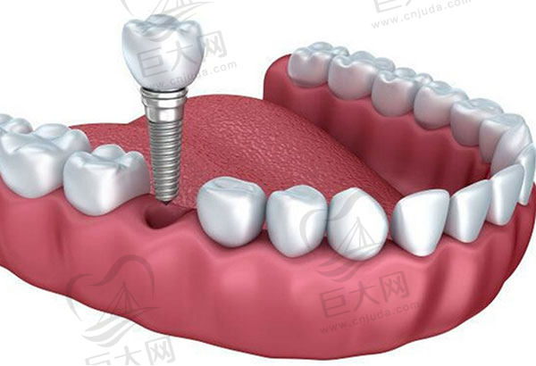 济南可恩口腔医院种植牙