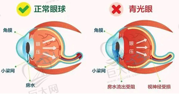 科普青光眼的早期症状6个表现，以及青光眼的发病原因