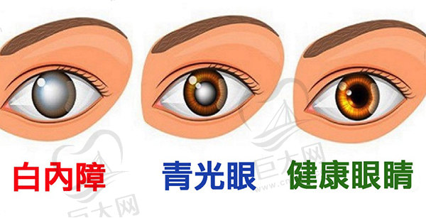 科普青光眼的早期症状6个表现，以及青光眼的发病原因
