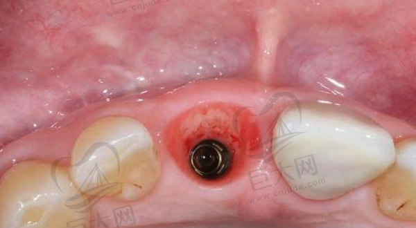 种植牙8大后遗症之种植体感染和炎症