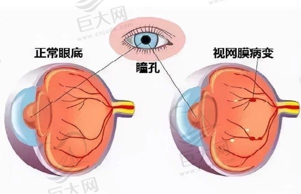 常见的眼底病都有哪些