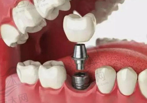 合肥种植牙收费标准