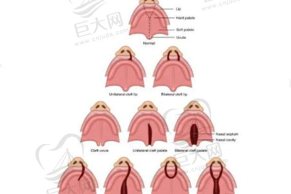 唇腭裂序列种类