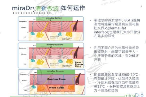 miradry微波腋臭治疗仪原理