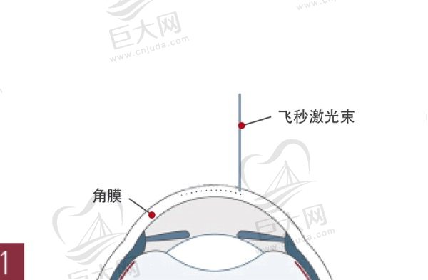 飞秒激光手术多久恢复到正常视力