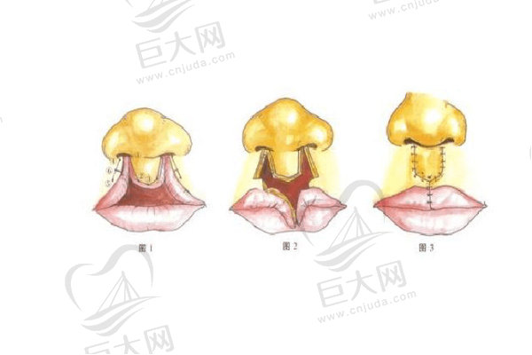 唇腭裂修复示意图