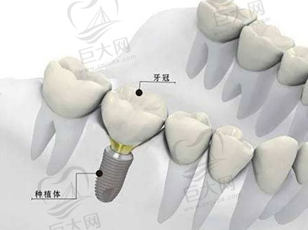 种一颗牙要多钱