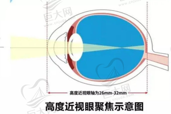 高度近视眼睛轴距变长