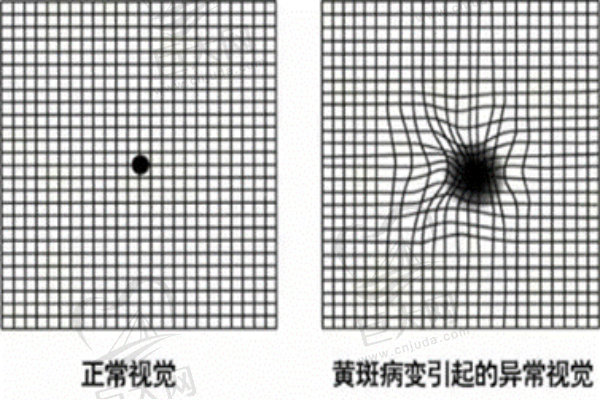 黄斑病变视觉异常