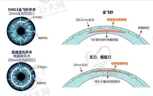 近视手术是越贵越好吗