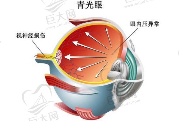 青光眼一定会失明吗