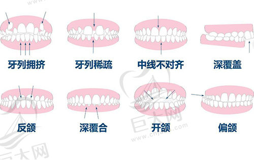 隐形矫正器和传统矫正器的区别是什么