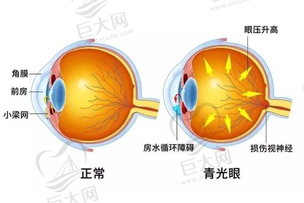 青光眼跟玩手机有关系吗？