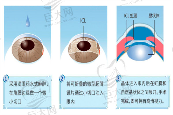 近视手术晶体植入技术