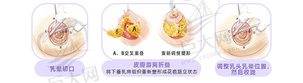 深圳南雅整形医院花苞提胸术