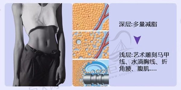 超脂塑超声乳化体雕技术优势