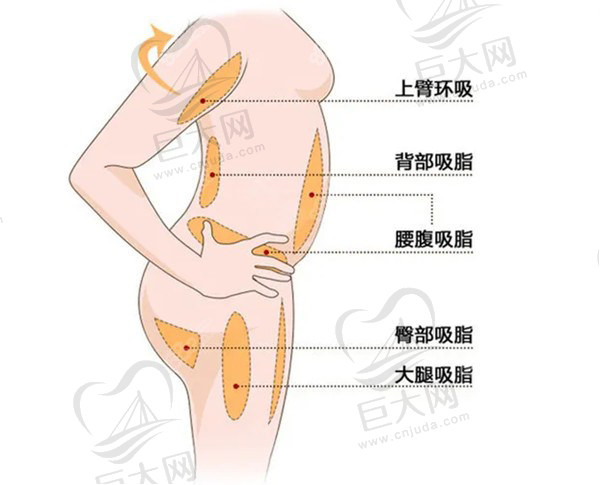 超脂塑吸脂和黄金微雕哪个好