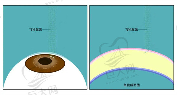 近视眼矫正手术