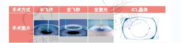 近视眼矫正手术