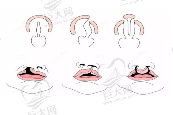 唇腭裂的各种形态