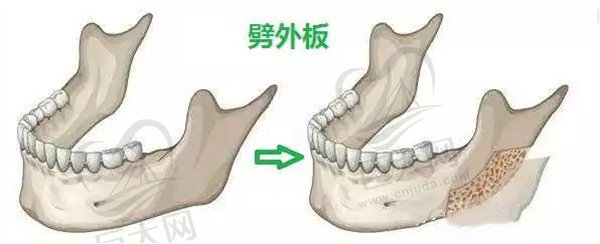 下颌角劈外板