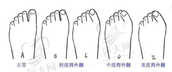 国内做大脚骨矫正手术医院排名盘点