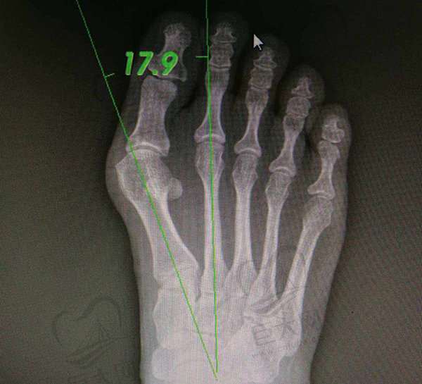 国内做大脚骨矫正手术医院排名盘点