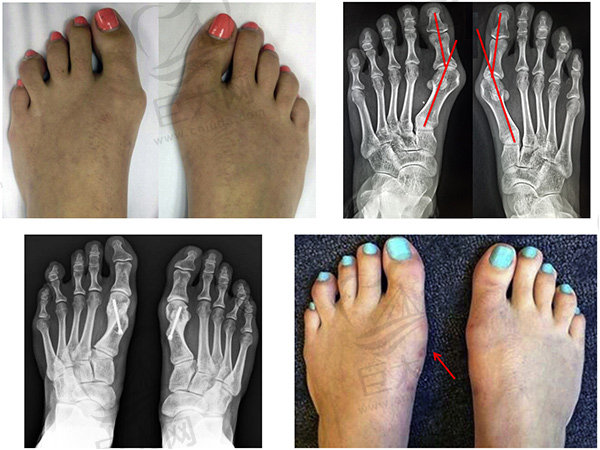 国内做大脚骨矫正手术医院排名盘点