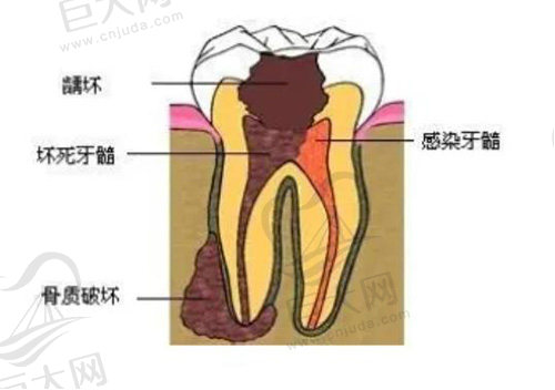 牙周炎有什么症状表现