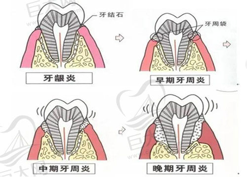 急性牙周炎的症状表现