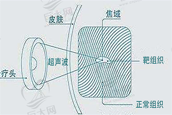 超声波结构