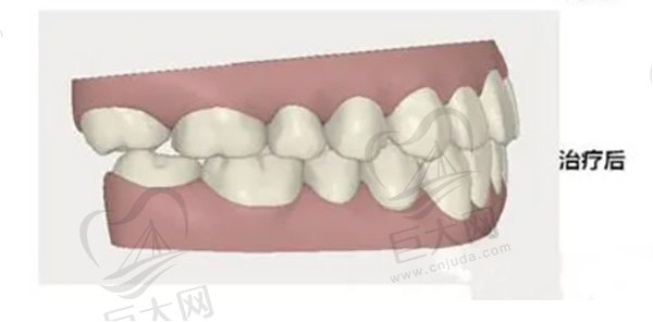 地包天戴牙套前后图（矫正后）