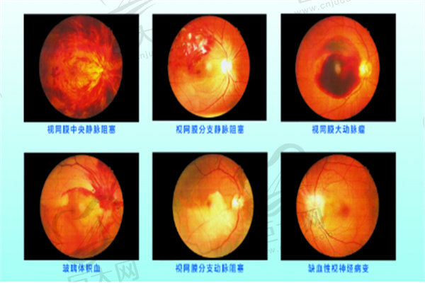 糖尿病眼底症状