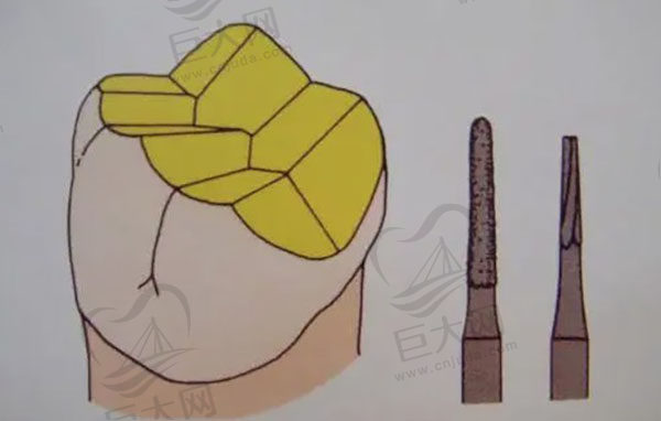 做全瓷牙套需要把牙齿磨的很小么