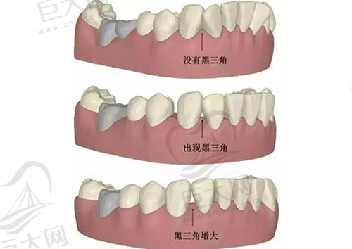 牙齿矫正黑三角图片