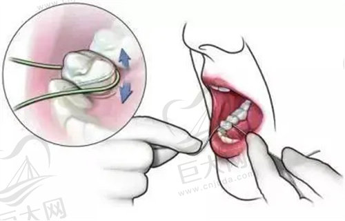 牙周病牙槽骨吸收可逆吗