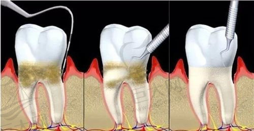 牙周病牙槽骨吸收可逆吗