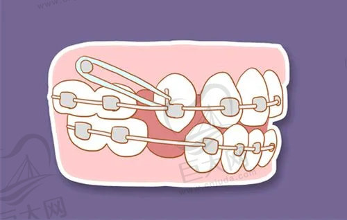 2023年牙齿矫正详解指南
