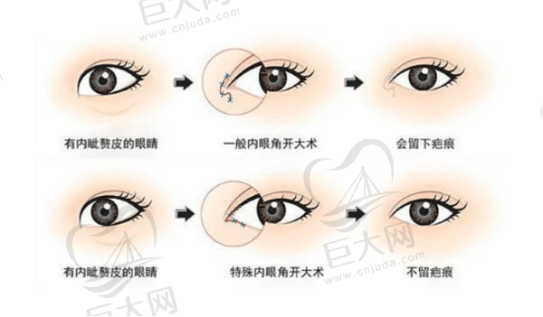 眼部整形手术多样化