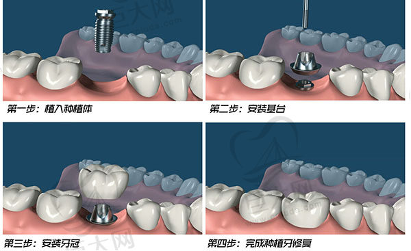 种牙过程